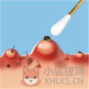 粉刺达人 粉刺达人